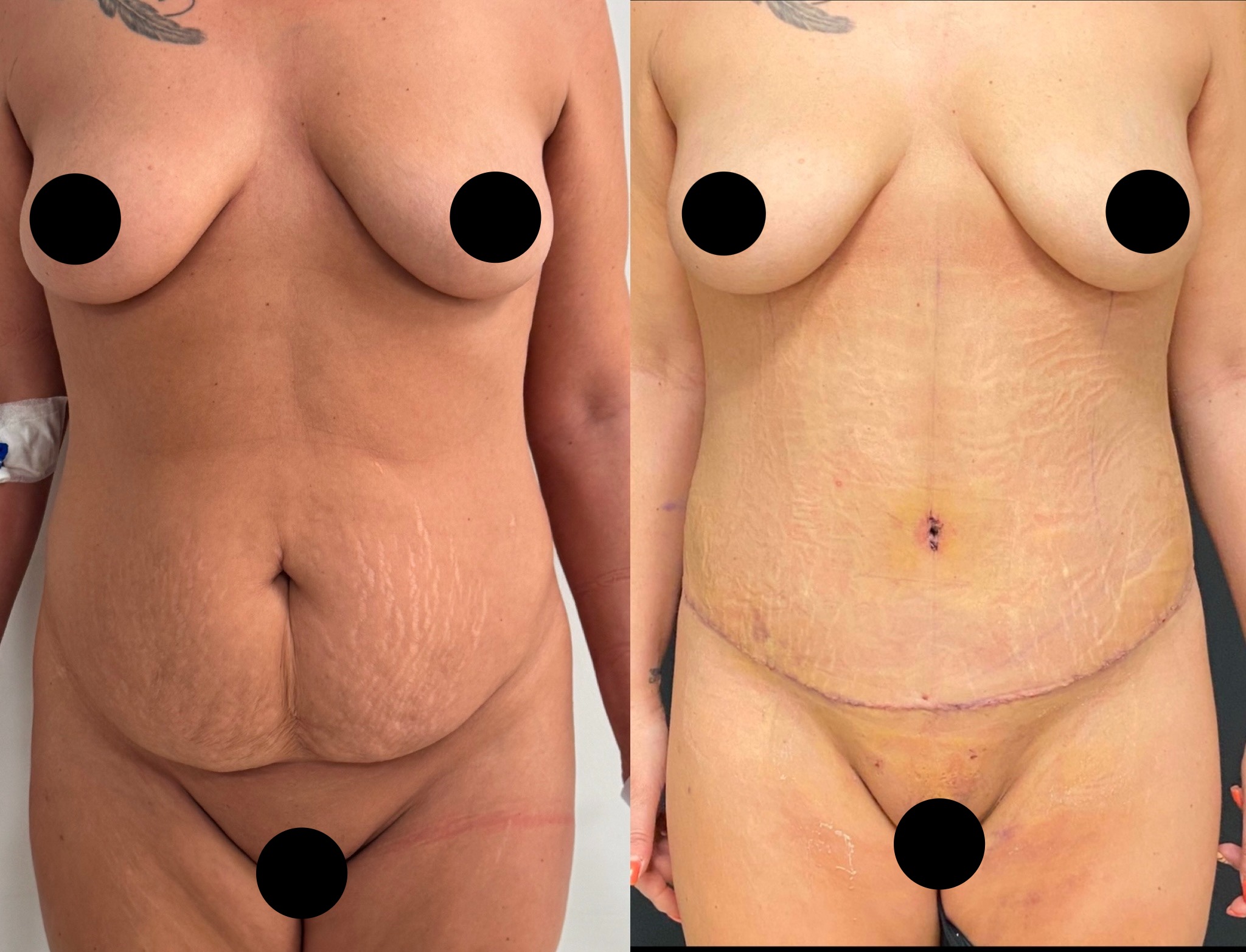 Tummy tuck before and after
