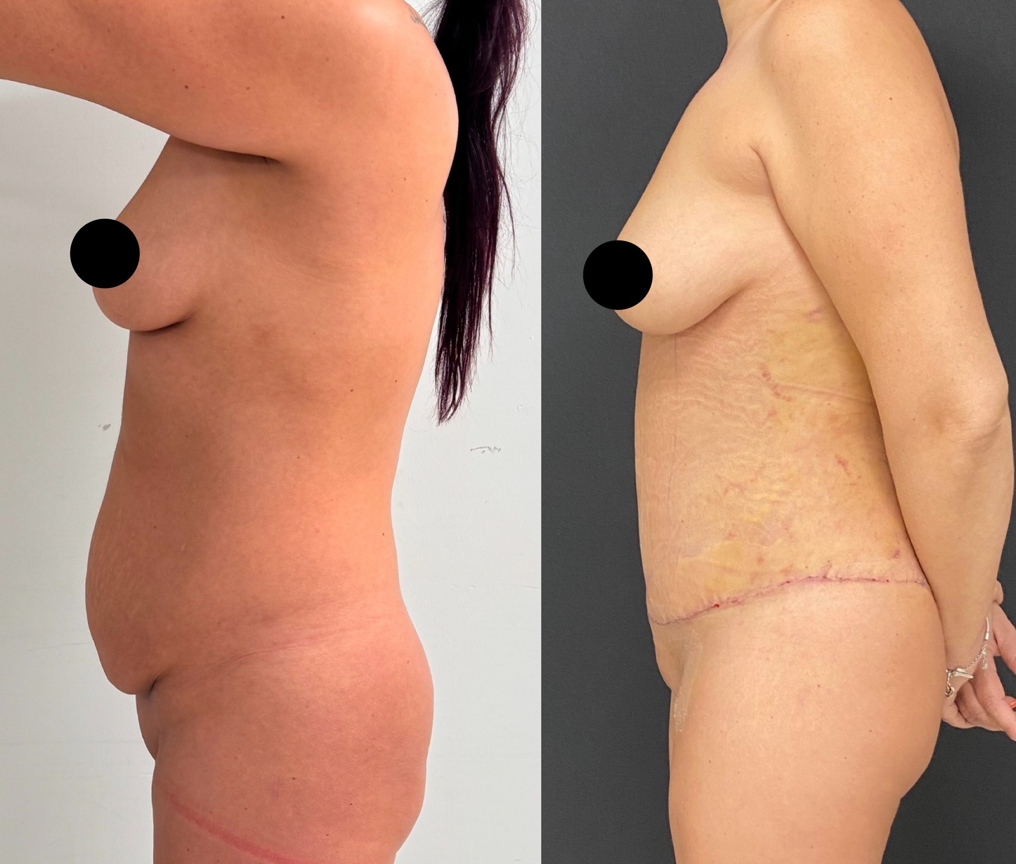 Tummy tuck before and after