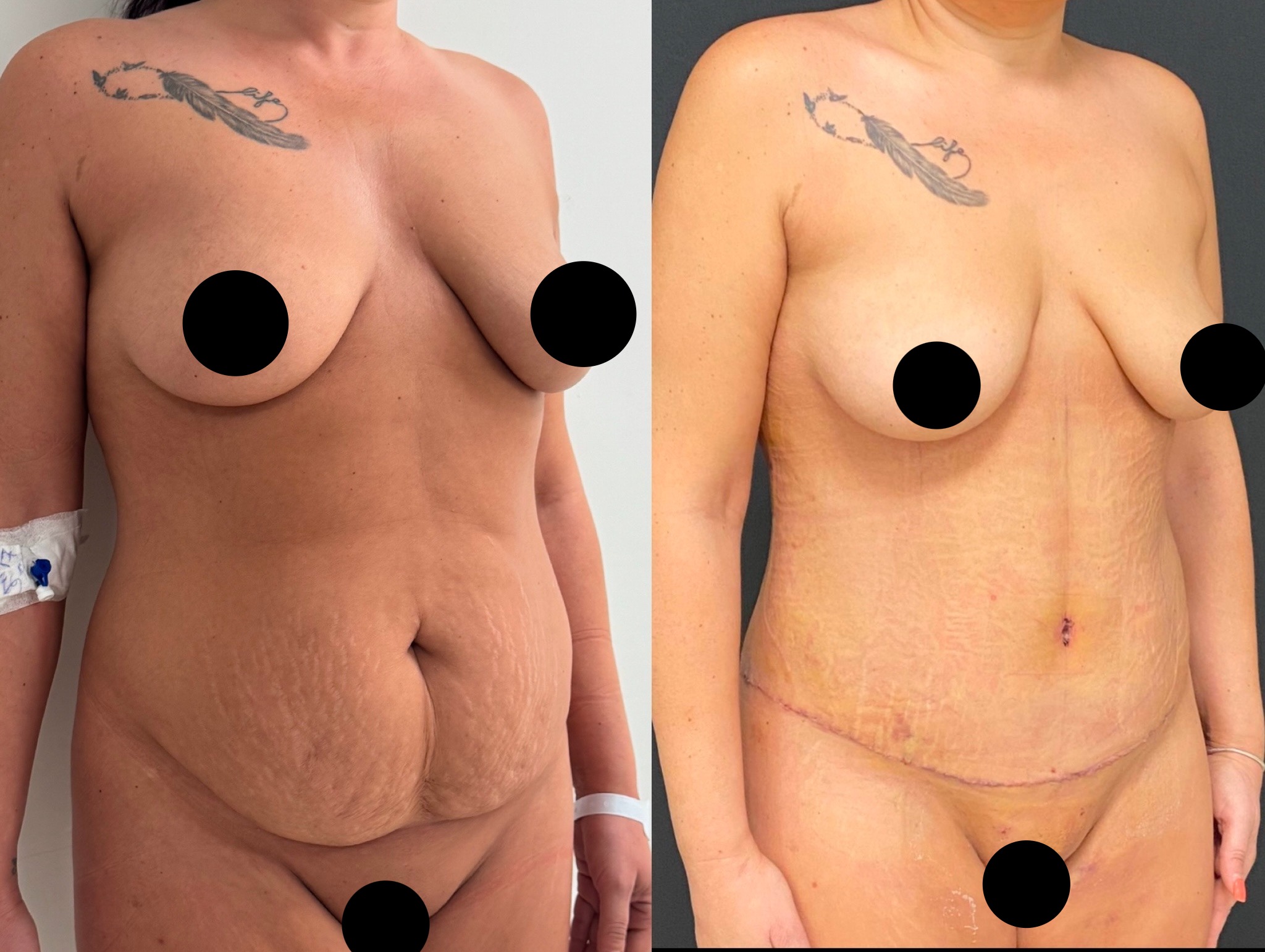 Tummy tuck before and after